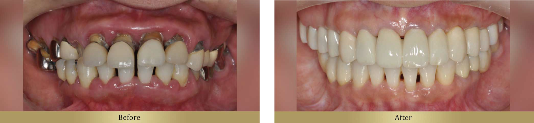 審美歯科治療のビフォーアフター
